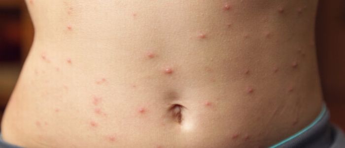 Morbillo, continua l'aumento dei casi in Europa