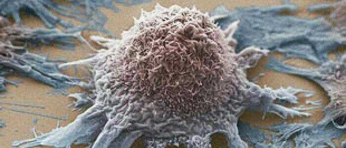 Tumori, scoperta proteina responsabile della crescita dei tumori