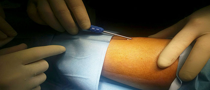 Catanzaro a tre giovani diabetici, impiantato un sensore per monitoraggio glicemia (Foto)