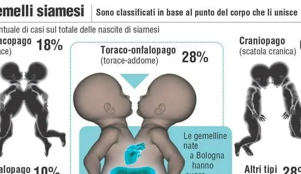 Roma, al Bambin Gesù gemelle siamesi separate con successo