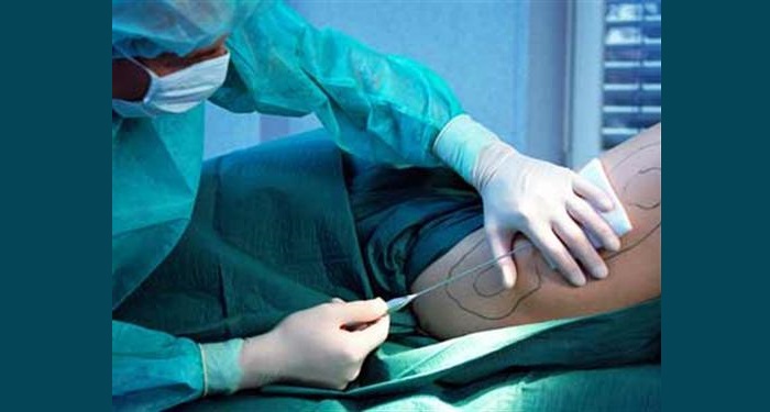 Liposuzione: tecnica, costi e rischi