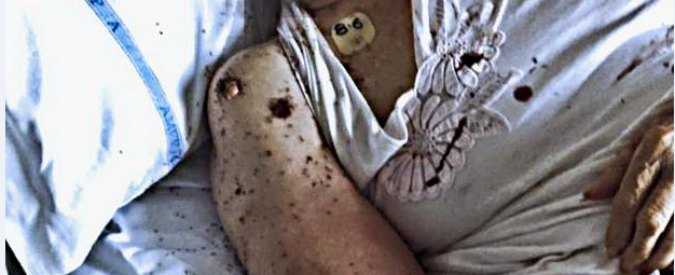 Napoli, donna ricoverata in ospedale ha il letto invaso di formiche. Lorenzin invia ispettori