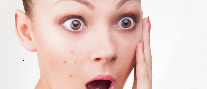 Follicolite: cause, rimedi ed accorgimenti