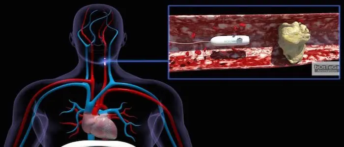 Salute, arriva MicroVast: la capsula "robotica" che pulisce il sangue