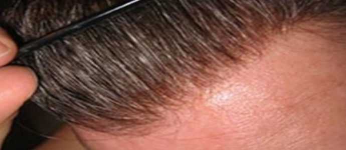 Protesi per capelli: la risposta alla calvizie discreta e non chirurgica