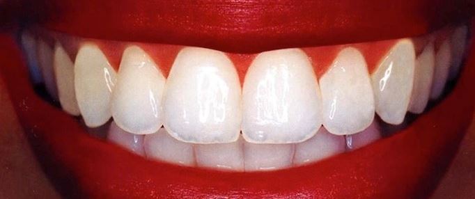 Un bicchiere di vino rosso e un sorriso in più contro la carie