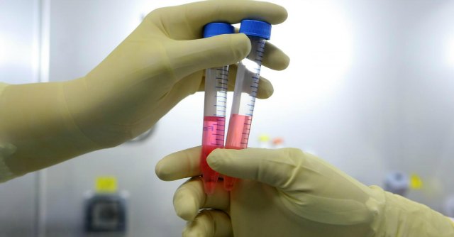 Sclerosi Laterale Amiotrofica: scoperto nuovo gene