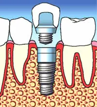 ANDIPavia: Insidie e vantaggi clinici negli impianti postestrattivi