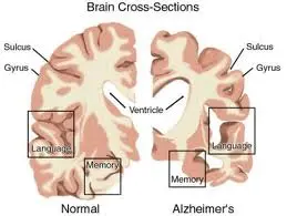 Alzheimer. La vitamina E può rallentare la progressione della malattia mentre viene scoperta l'area