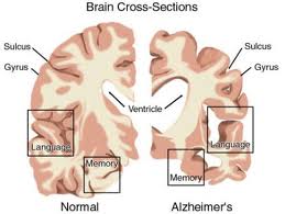 Alzheimer. La vitamina E può rallentare la progressione della malattia mentre viene scoperta l'area