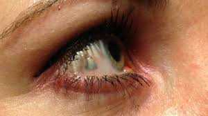 Una pericolosa moda: impiantare gioielli negli occhi