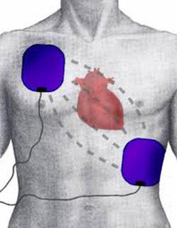 Regione Marche, avvio del programma di diffusione dei defibrillatori