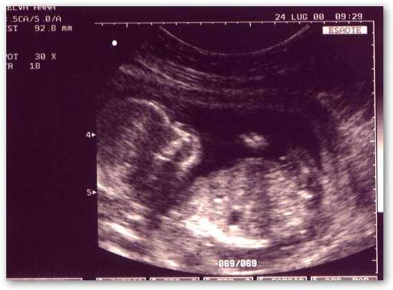 Gran Bretagna: scandalo aborti selettivi non denunciati