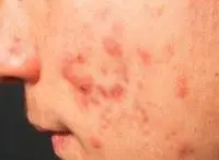 Acne: il Roaccutan efficace ma associato a gravi effetti indesiderati