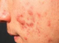 Acne: il Roaccutan efficace ma associato a gravi effetti indesiderati