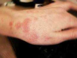 Allergia e anafilassi. Un neonato su 10 soffre di allergia alimentare