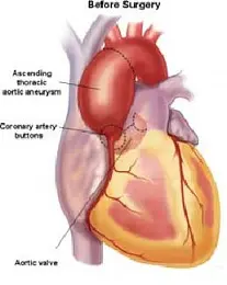 Terzo simposio internazionale sul trattamento delle patologie dell'aorta toracica