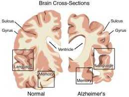 Morbo di Alzheimer: scoperti effetti positivi della proteina che lo causa