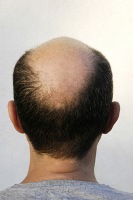 Calvizie: arriva la 'cura del vampiro'. Lo dice uno studio italo-israeliano