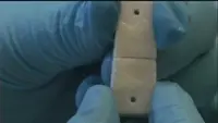 Stop alle placche di metallo. Le fratture  saranno ridotte con la colla