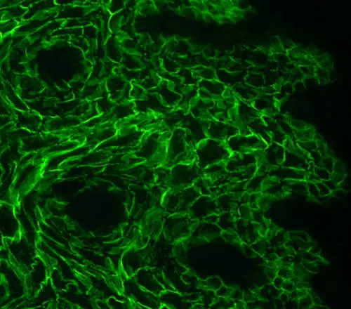 Scoperti i meccanismi delle malattie autoimmuni