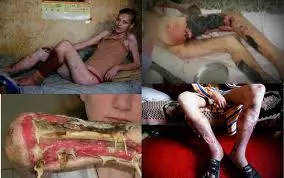 Krokodil, la droga che uccide in tre anni con effetti devastanti per la pelle