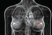 Tumore al seno: scienziati australiani hanno scoperto processo per fermarne diffusione