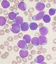 Il reparto di ematologia di Caltanissetta si avvia pian piano ad essere un reparto di eccellenza.
