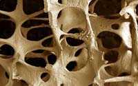 Avviato nell'Asp di Cosenza il progetto per la prevenzione delle fratture da osteoporosi