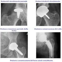 Dopo le PIP allarme arriva dalla Gran Bretagna su protesi dell'anca metalliche