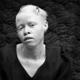 Camerun: il dramma degli africani albini