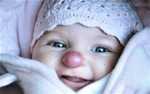 Nasce con naso da clown, operata a tre anni