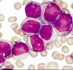 Individuata una chiave genica per combattere la leucemia