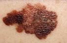 Melanoma: due italiani su tre non controlla i nei