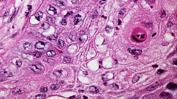 Cancro ai polmoni importante scoperta che permette la diagnosi con 2 anni di anticipo