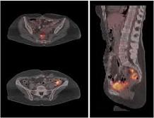 Scoperto il gene del tumore ovarico: ricerca tutta italiana