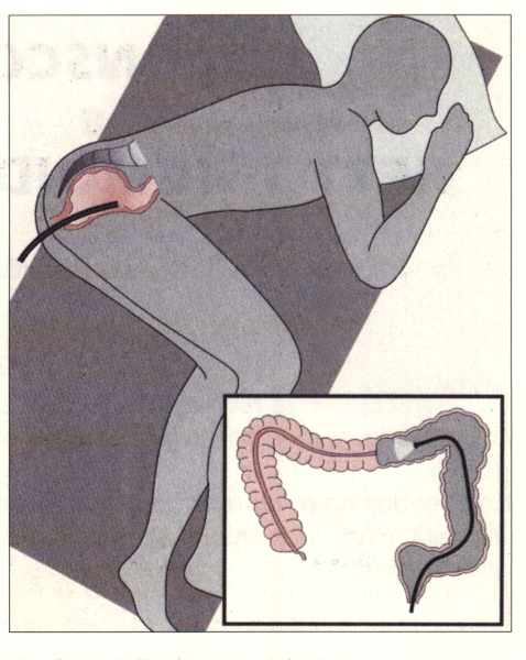 Cancro al colon: addio colonscopia, arrivano due test di dna per individuare e curare il problema