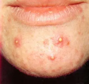Un cerotto hi-tech per combattere l'acne