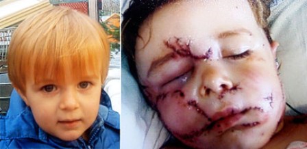 Londra: bambino attaccato dai cani, 200 punti di sutura