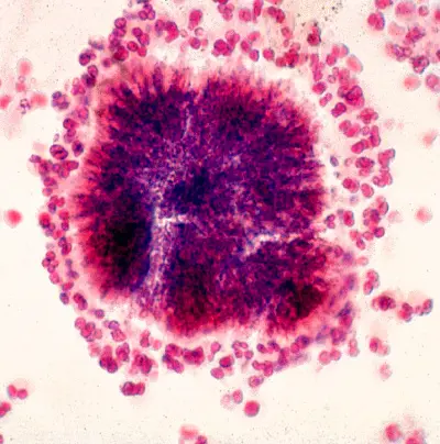 Sei casi di tubercolosi nel livornese