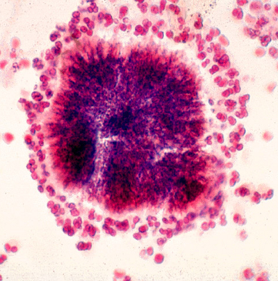 Sei casi di tubercolosi nel livornese