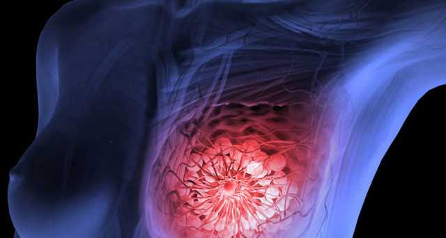 Tumori: da antibiotici nuova speranza di cura contro cancro al seno