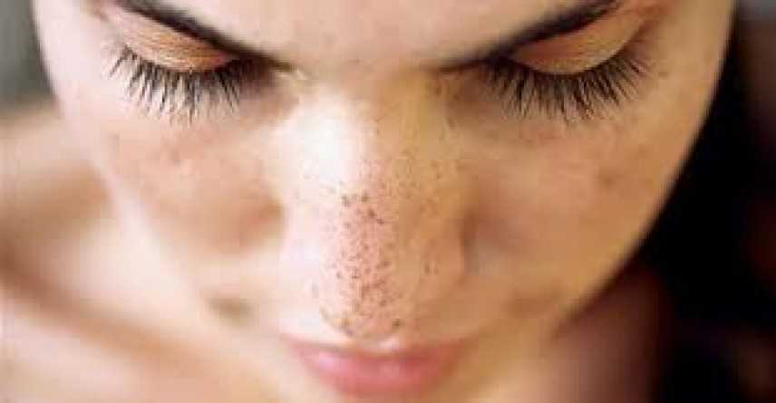 Pelle del viso: come prevenire, riconoscere e curarne le macchie