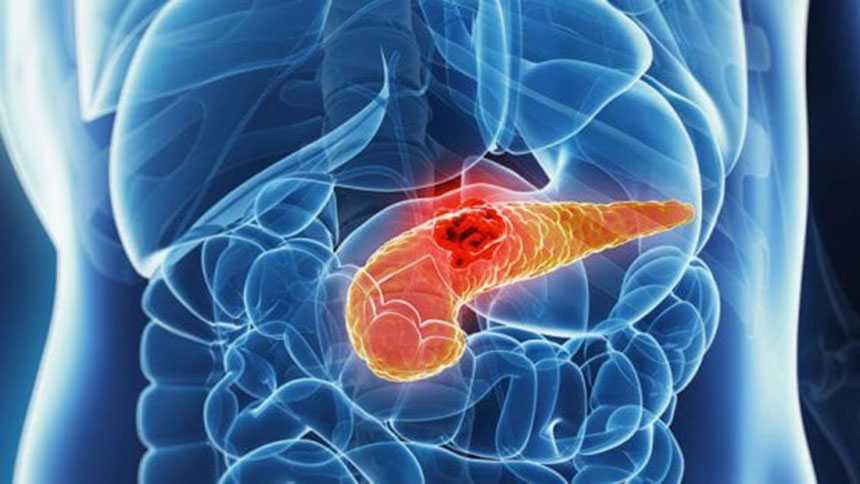 Tumore pancreas, nuova cura dimezza progressione malattia