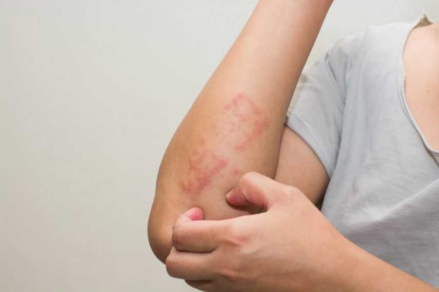 Dermatite da sudore: ecco come curarla