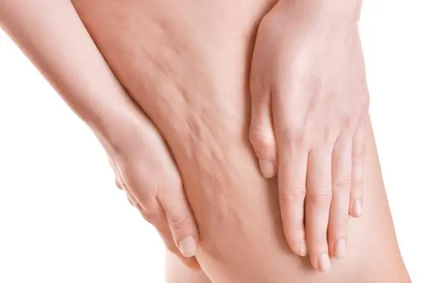 Cellulite: ecco le regole per combatterla