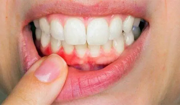 Salute gengivale in Italia: aumento della parodontite e nuovi rischi legati all’ambiente